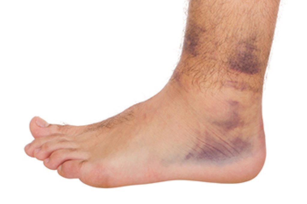 Understanding Ankle Sprains and Their Symptoms