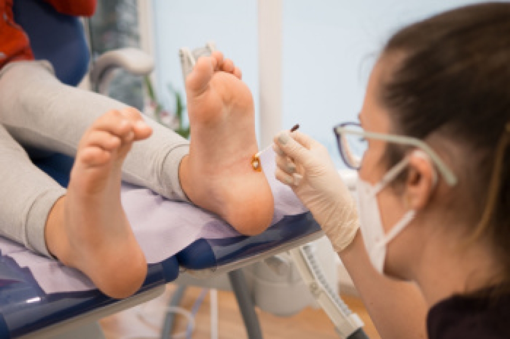 How to Treat Plantar Warts