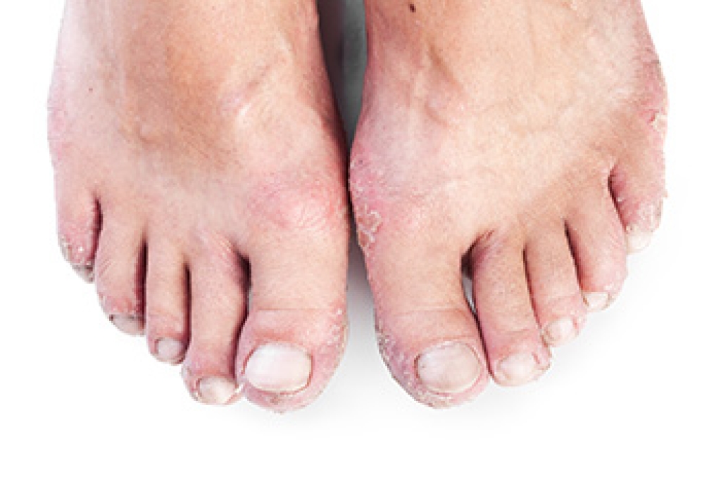 Psoriatic Arthritis Symptoms in the Feet and Ankles