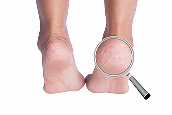 How to Remove Dead Skin from Your Feet - ePodiatrists