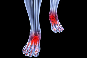 Arthritic foot and ankle care treatment in the Wheeling, IL 60090 and Chicago, IL 60640 area