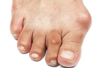 Bunions treatment in Chicago, IL 60640 and Wheeling, IL 60090