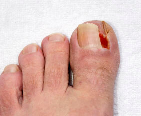 ingrown toenail in the Wheeling, IL 60090 and Chicago, IL 60640 area