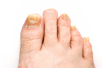 toenail fungus treatment in the Wheeling, IL 60090 and Chicago, IL 60640 area