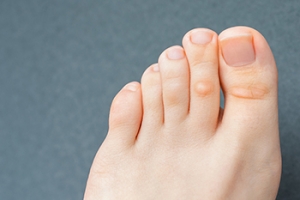 What to Do When You Have a Corn on Your Foot