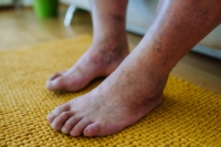 Support in Diabetic Foot Care