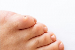 Three Types of Corns on the Feet
