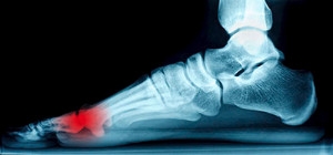 An Overview of Sesamoiditis
