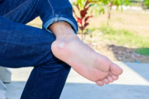 Treating Stubborn Plantar Warts
