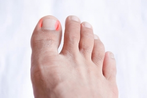 Tips for Preventing Ingrown Toenails