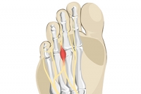 What Can Cause Radiating Pain in the Toes?
