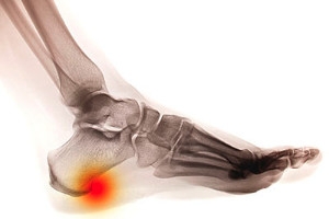What is a Heel Spur, Anyway?