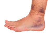 How to Treat Ankle Sprains
