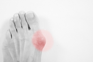 Where Does a Bunion Develop?