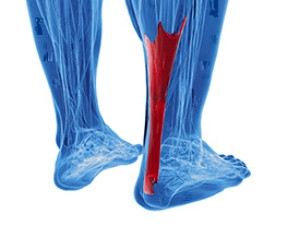 Defining an Achilles Tendon Rupture