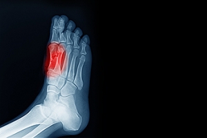 Diagnosis and Treatment of Sesamoiditis