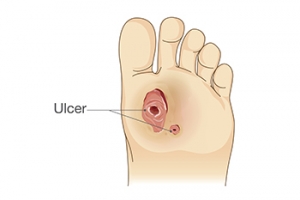 A Cut on the Foot Is Not So Simple for Diabetic Patients