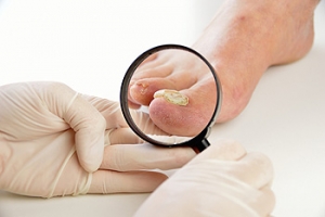 Common Signs You May Have Toenail Fungus